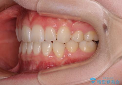 【モニター】口が閉じにくい 膨らんだ口元を抜歯矯正ですっきりとの治療後