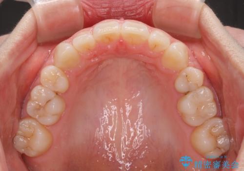 【モニター】口が閉じにくい 膨らんだ口元を抜歯矯正ですっきりとの治療後
