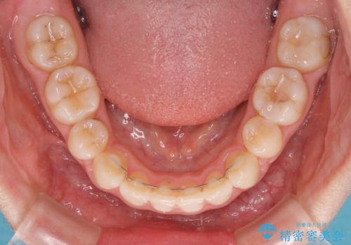 【モニター】口が閉じにくい 膨らんだ口元を抜歯矯正ですっきりとの治療後