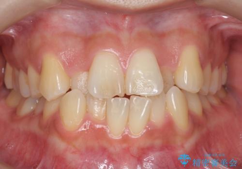 前歯のがたつき、中に入ってしまっている 部分矯正で低予算での治療前