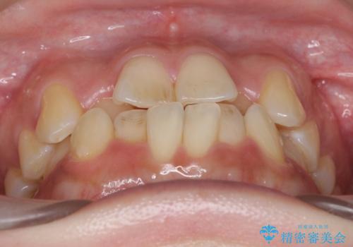 前歯のがたつき、中に入ってしまっている 部分矯正で低予算での治療前