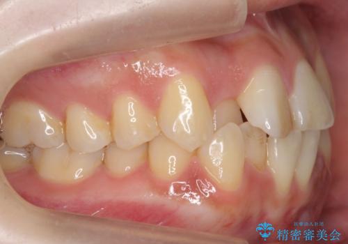 前歯のがたつき、中に入ってしまっている 部分矯正で低予算での治療前