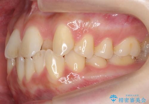 前歯のがたつき、中に入ってしまっている 部分矯正で低予算での治療前