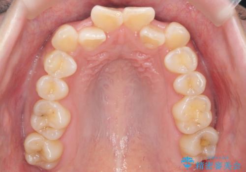 前歯のがたつき、中に入ってしまっている 部分矯正で低予算での症例 治療前