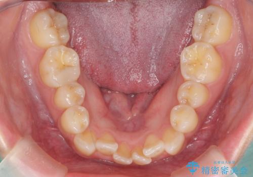 前歯のがたつき、中に入ってしまっている 部分矯正で低予算での治療前