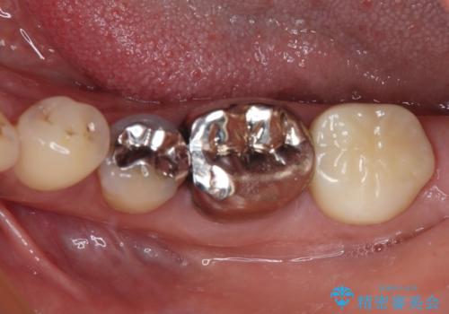 銀歯の下のむし歯で欠けてしまった歯　オールセラミッククラウン治療の症例 治療後