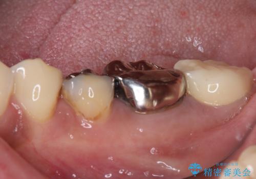 銀歯の下のむし歯で欠けてしまった歯 オールセラミッククラウン治療の治療後