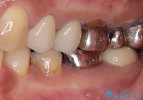 銀歯の下のむし歯で欠けてしまった歯 オールセラミッククラウン治療の治療後