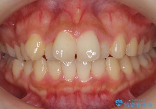 前歯の出っ歯とねじれ　短期間できれいに!　部分矯正とセラミックの組み合わせ治療の症例 治療前