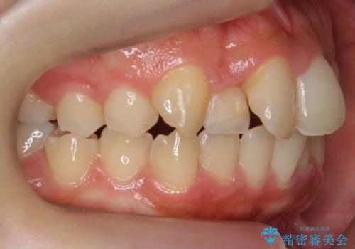 前歯の出っ歯とねじれ 短期間できれいに! 部分矯正とセラミックの組み合わせ治療の治療前