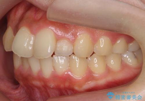 前歯の出っ歯とねじれ 短期間できれいに! 部分矯正とセラミックの組み合わせ治療の治療前