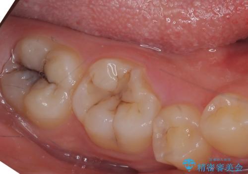 奥歯の高さがない　歯周外科処置で解決　(クラウンレングスニング)の症例 治療前