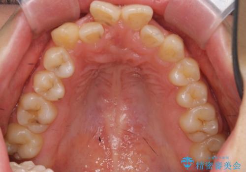 前歯の出っ歯とねじれ 短期間できれいに! 部分矯正とセラミックの組み合わせ治療の治療前