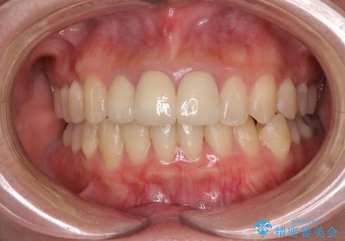 前歯の黒い縁を綺麗にしたい 前歯のオールセラミックの治療後