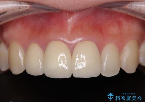 前歯の黒い縁を綺麗にしたい　前歯のオールセラミックの症例 治療後