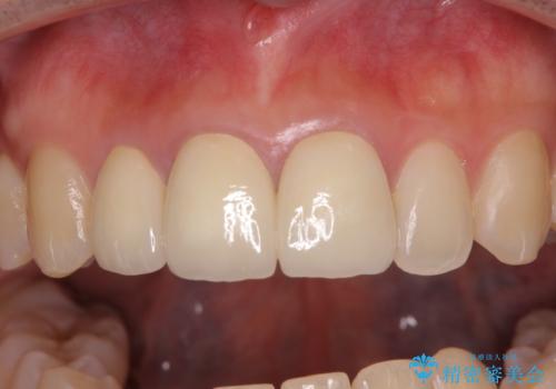 前歯の黒い縁を綺麗にしたい 前歯のオールセラミックの治療後