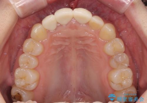 前歯の黒い縁を綺麗にしたい 前歯のオールセラミックの治療後