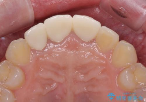前歯の黒い縁を綺麗にしたい 前歯のオールセラミックの治療後