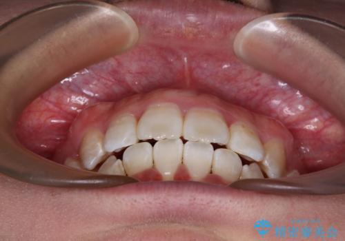 唇からはみ出るほど飛び出した前歯 ワイヤー装置による抜歯矯正の治療後