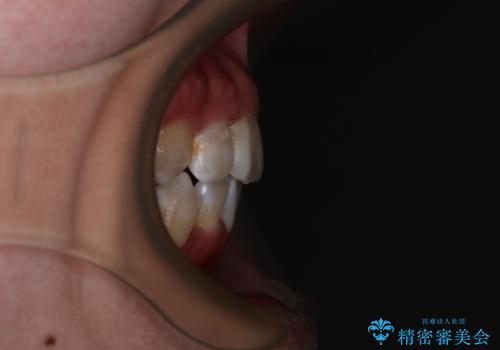 唇からはみ出るほど飛び出した前歯　ワイヤー装置による抜歯矯正の治療後