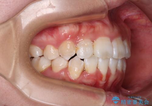唇からはみ出るほど飛び出した前歯　ワイヤー装置による抜歯矯正の治療後
