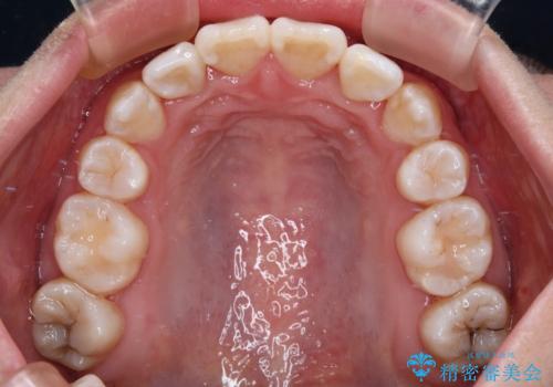唇からはみ出るほど飛び出した前歯 ワイヤー装置による抜歯矯正の治療後