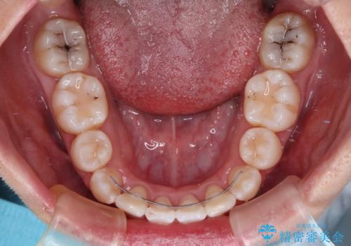 唇からはみ出るほど飛び出した前歯 ワイヤー装置による抜歯矯正の治療後