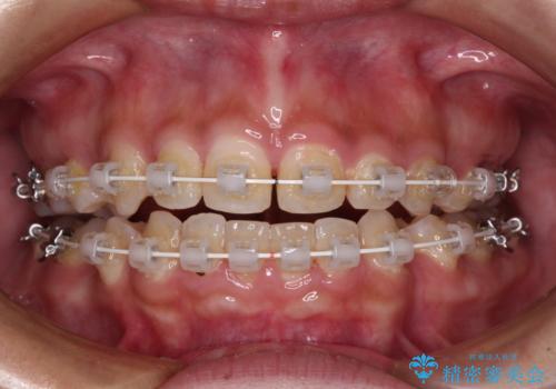 前に出ている上顎 抜歯矯正で唇を閉じやすくの治療中