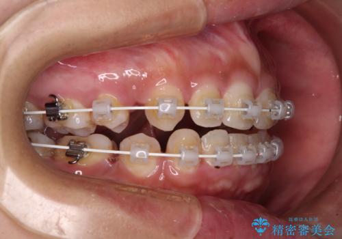 前に出ている上顎 抜歯矯正で唇を閉じやすくの治療中