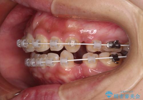 前に出ている上顎 抜歯矯正で唇を閉じやすくの治療中