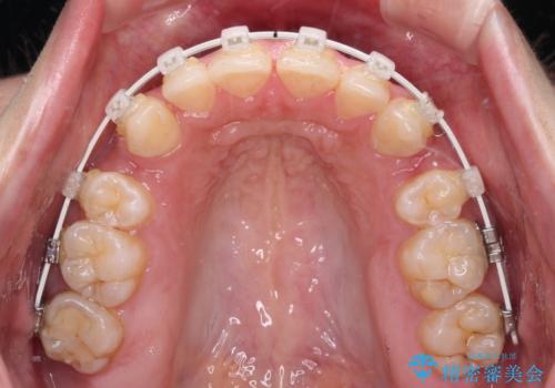 前に出ている上顎 抜歯矯正で唇を閉じやすくの治療中
