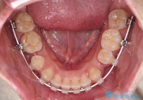前に出ている上顎 抜歯矯正で唇を閉じやすくの治療中