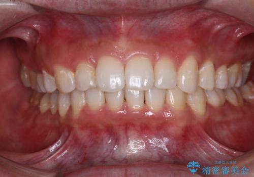 【モニター】前歯に隙間ができるほどのディープバイト　ワイヤー装置で負担の少ない咬み合わせにの症例 治療後