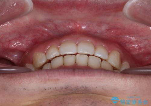 【モニター】前歯に隙間ができるほどのディープバイト ワイヤー装置で負担の少ない咬み合わせにの治療後