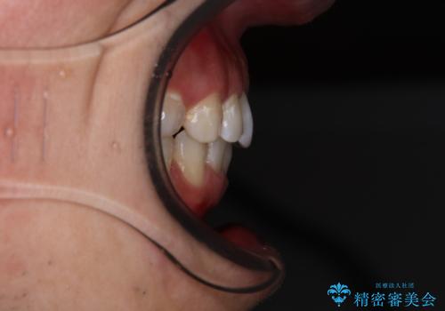 【モニター】前歯に隙間ができるほどのディープバイト ワイヤー装置で負担の少ない咬み合わせにの治療後