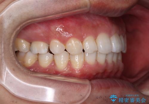 【モニター】前歯に隙間ができるほどのディープバイト ワイヤー装置で負担の少ない咬み合わせにの治療後