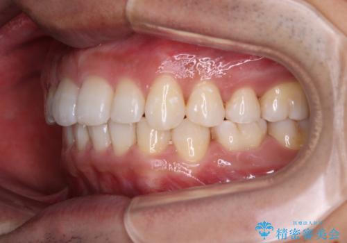 【モニター】前歯に隙間ができるほどのディープバイト ワイヤー装置で負担の少ない咬み合わせにの治療後