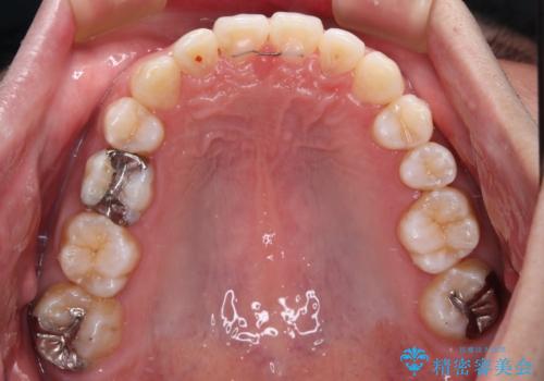 【モニター】前歯に隙間ができるほどのディープバイト　ワイヤー装置で負担の少ない咬み合わせにの治療後
