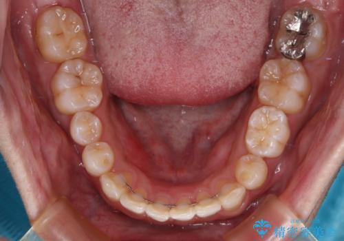 【モニター】前歯に隙間ができるほどのディープバイト ワイヤー装置で負担の少ない咬み合わせにの治療後