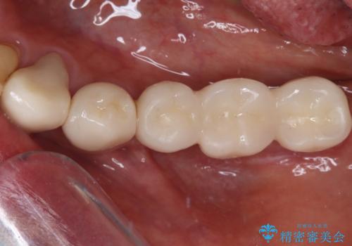入れ歯を使いたくない　細い骨にインプラントを埋入した補綴治療
