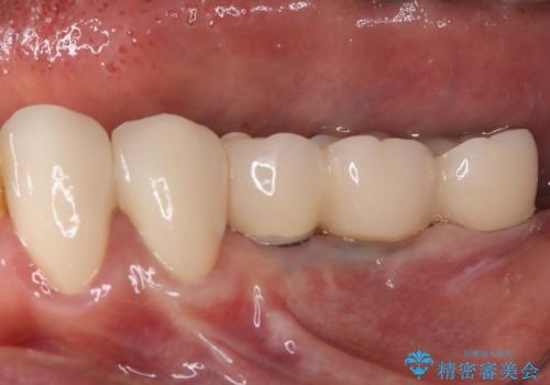 入れ歯を使いたくない　細い骨にインプラントを埋入した補綴治療の治療後