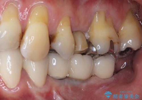 入れ歯を使いたくない　細い骨にインプラントを埋入した補綴治療の治療後