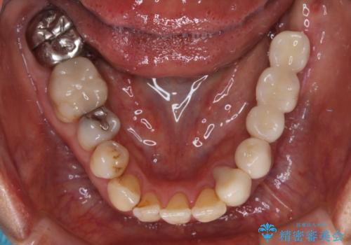 入れ歯を使いたくない 細い骨にインプラントを埋入した補綴治療の治療後