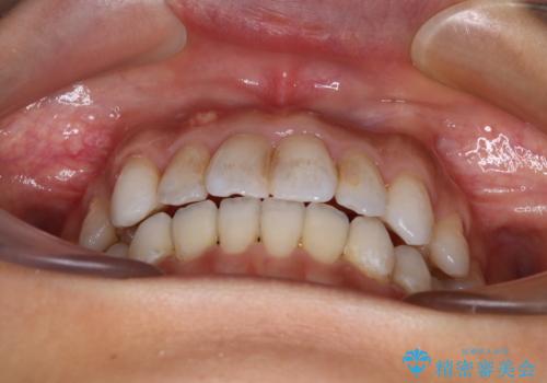 【モニター】開咬を治したい インビザラインによる矯正治療の治療後