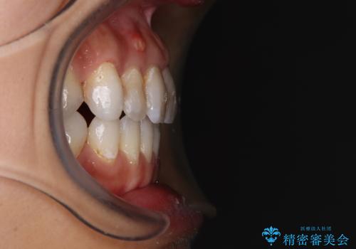 【モニター】開咬を治したい インビザラインによる矯正治療の治療後