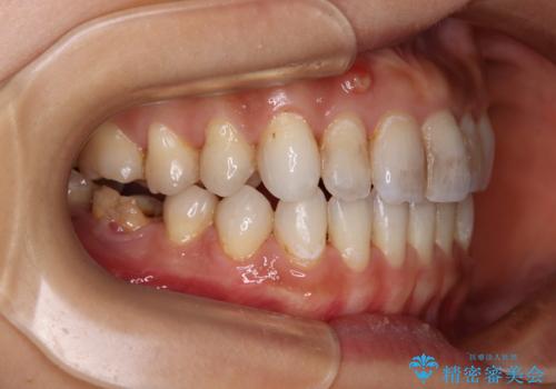 【モニター】開咬を治したい インビザラインによる矯正治療の治療後