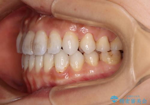 【モニター】開咬を治したい インビザラインによる矯正治療の治療後