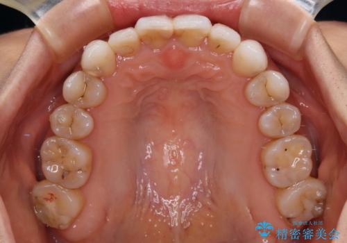 【モニター】開咬を治したい インビザラインによる矯正治療の治療後
