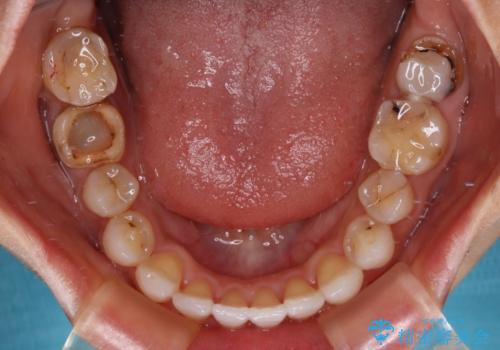 【モニター】開咬を治したい インビザラインによる矯正治療の治療後