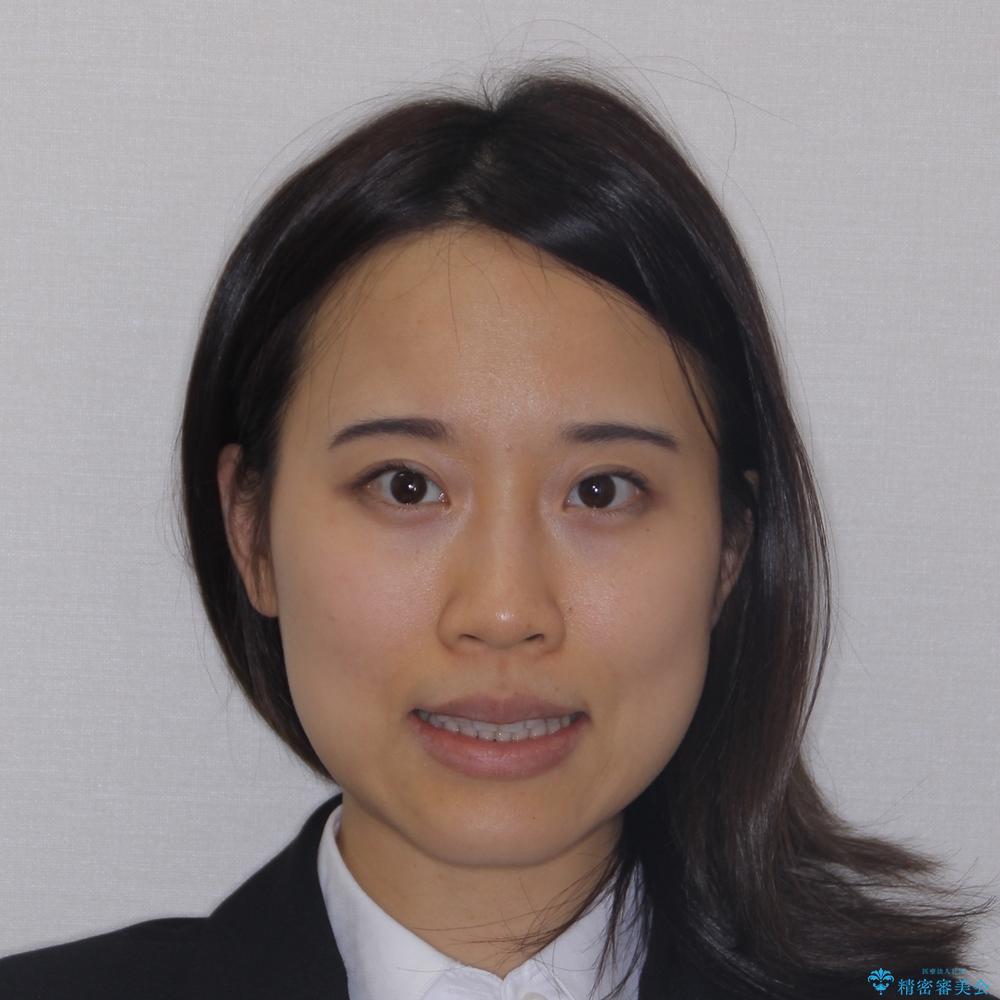 【モニター】開咬を治したい インビザラインによる矯正治療の治療後(顔貌)